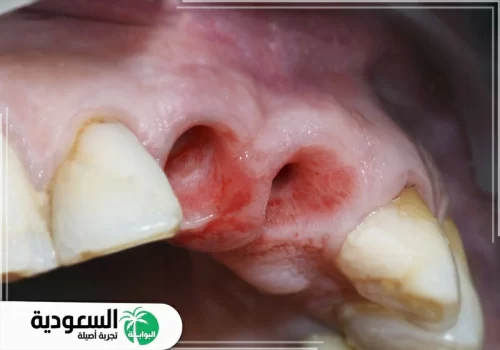 تفسير سقوط الاسنان في الحلم
