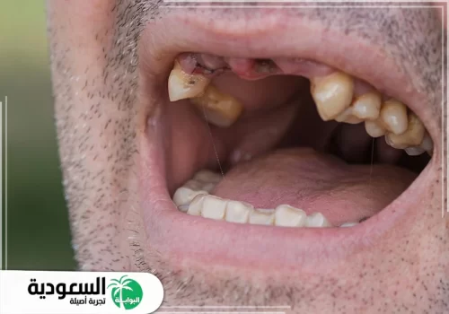 سقوط الاسنان في الحلم