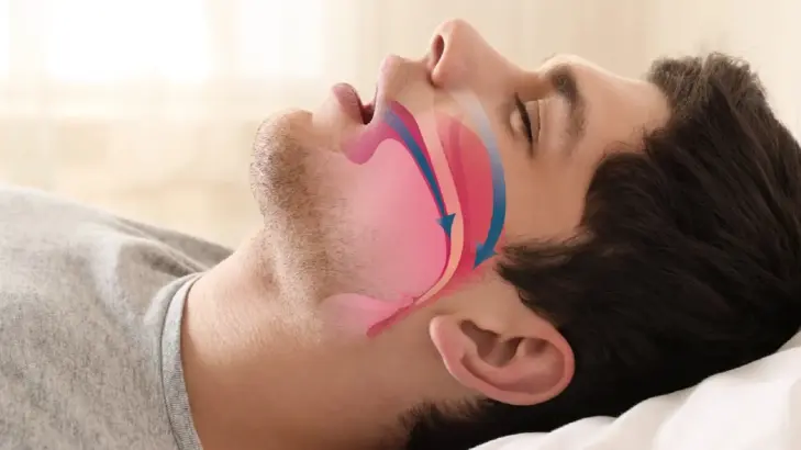 انقطاع النفس النومي: الأعراض، الأسباب، وأحدث طرق العلاج المبتكرة