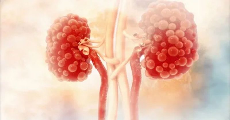 تكيسات الكلى: تأثيرها على نوعية الحياة وكيفية تحسينها