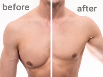 تكلفة علاج التثدي عند الرجال في ايران: دليل شامل