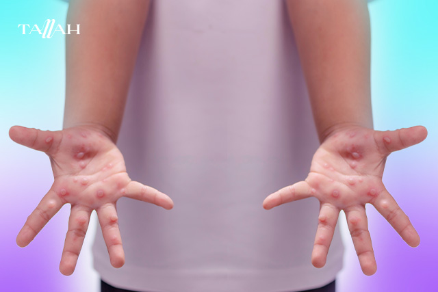 فيروس اليد والقدم والفم: الأعراض، الأسباب، العلاج، والوقاية