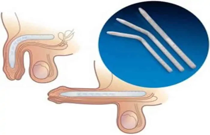 زراعة القضيب: الحلول المتاحة والتقنيات الحديثة