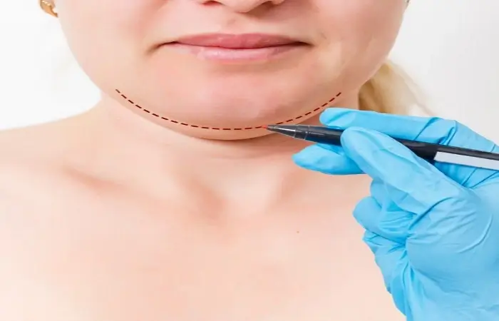 وداعاً للذقن المزدوجة: تفاصيل عملية شفط الدهون والتعافي