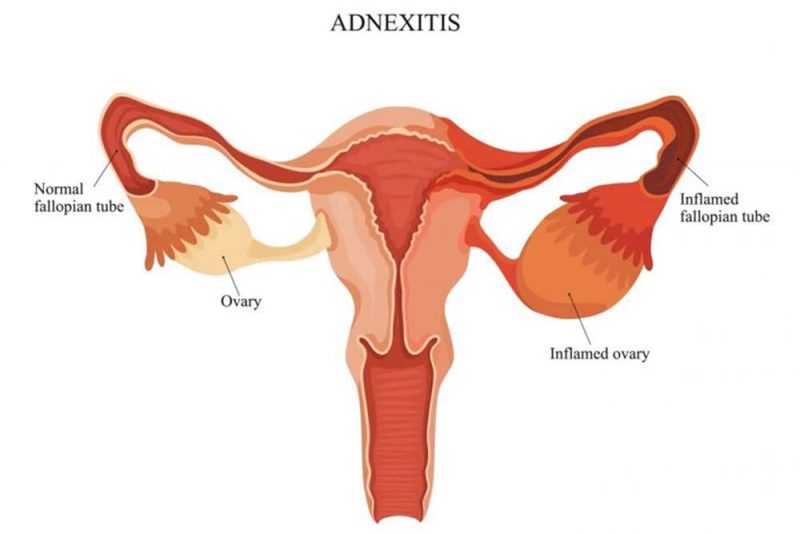 انسداد قناتي فالوب: خطوتكِ الأولى نحو تحقيق حلم الأمومة