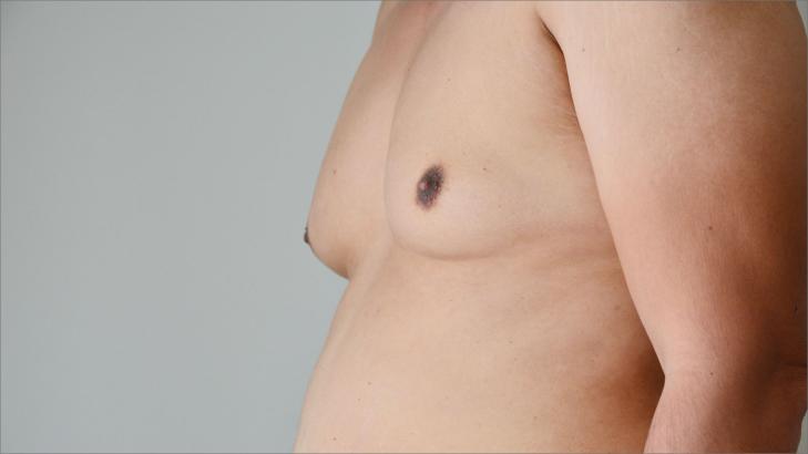 التثدي عند الرجال: حلول فعالة لتحسين المظهر والصحة