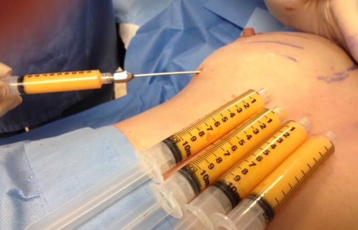 تكبير الصدر بالدهون الذاتية: كل ما يهمك