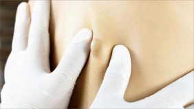 الورم الشحمي: فهم الأسباب والوقاية والعلاجات المتاحة