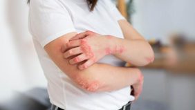 فطريات الجلد: نصائح للعناية اليومية للوقاية والعلاج