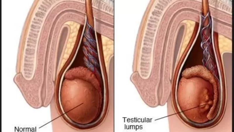 احتقان الخصية: الأعراض المبكرة وكيفية التعامل معها