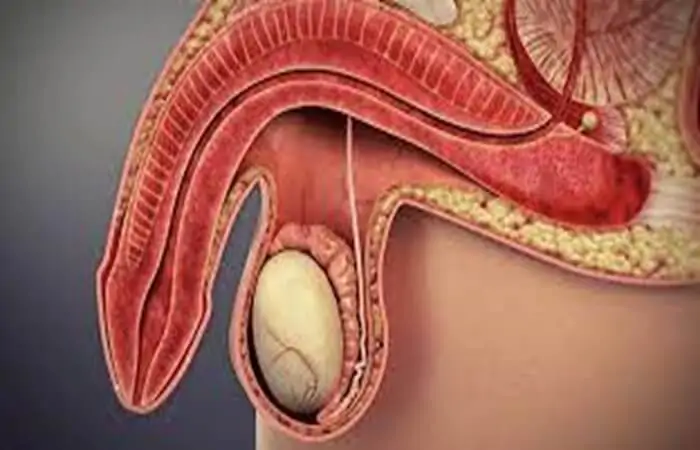 انحناء القضيب: الأعراض، الأسباب والعلاج