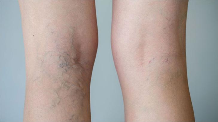 دوالي الساقين: نصائح للتعامل مع الألم والتورم