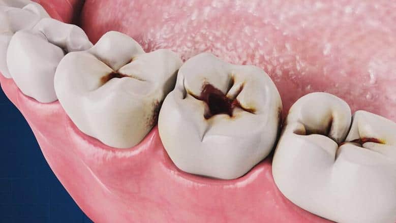 وداعًا لمشاكل الأسنان: القيقب يقدم علاجًا طبيعيًا لمكافحة التسوس
