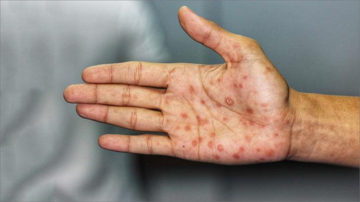 دليلك السريع للتعامل مع مرض الزهري بفعالية وأمان