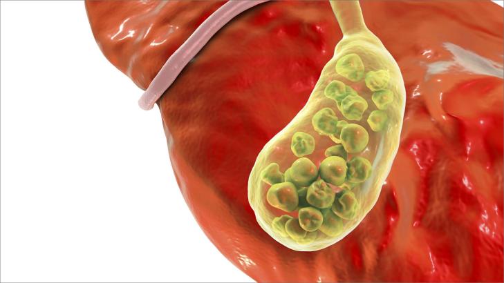 حصيات المرارة: كل ما يهمك معرفته عن التشخيص والعلاج والوقاية