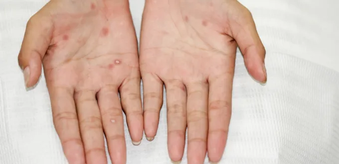 كل ما يخص مرض الزهري: من الإصابة الأولية إلى التأثيرات المزمنة