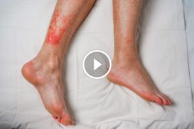 دليل شامل لـ حساسية حشرة الفراش: الأعراض، العلاج، والوقاية النهائية