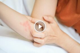 حل مشكلة لدغات بق الفراش: خطوة بخطوة نحو منزل آمن