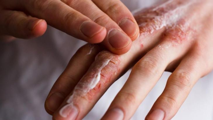 مستقبل علاج مرض السماك: آمال جديدة في الأبحاث الطبية