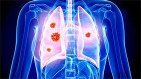 الوقاية من سرطان الرئة: استراتيجيات فعالة لحياة صحية