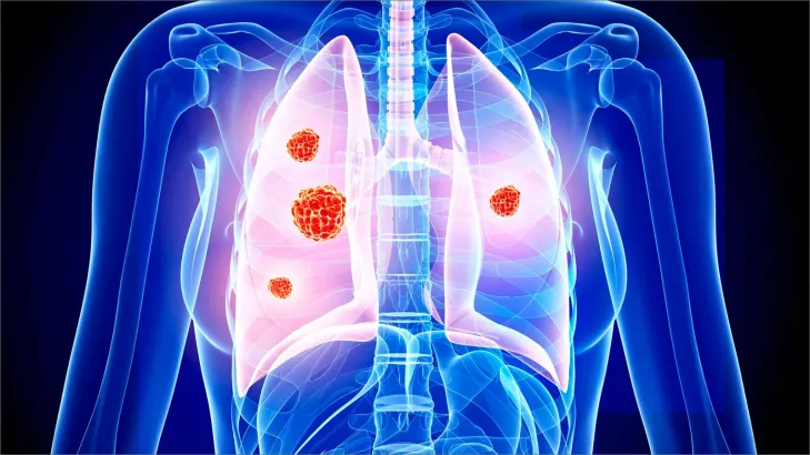 الوقاية من سرطان الرئة: استراتيجيات فعالة لحياة صحية