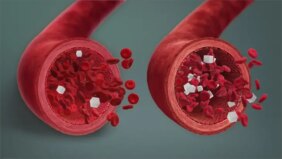 كل ما تحتاج معرفته عن ارتفاع الكالسيوم في الدم: الأسباب والعلاج الفعال