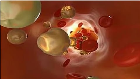 استشاري: ضعف الغدة الدرقية يؤدي إلى ارتفاع الكوليسترول