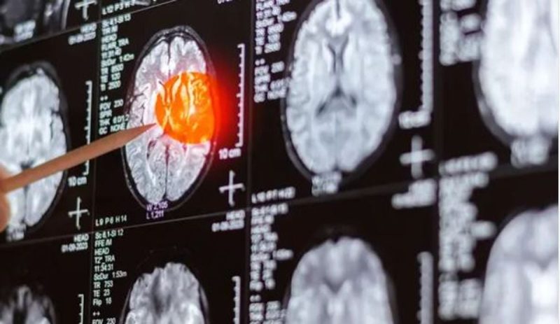 دليل شامل حول النافذة العلاجية الجديدة في علاج سرطان الدماغ
