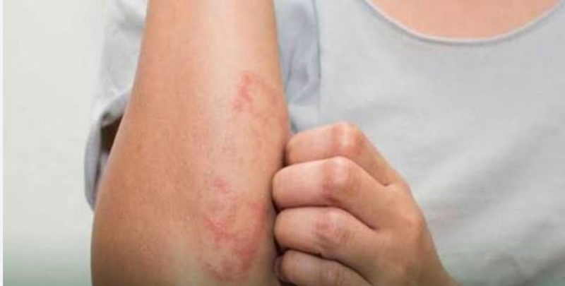 التهاب الجلد القيحي: رسالة مشفرة من جهازك المناعي لك